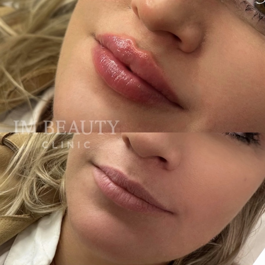 Läppfiller 1 ml, före och efter