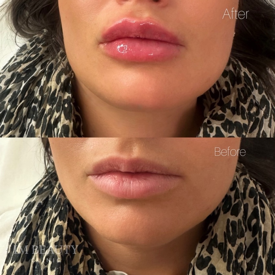 Läppfiller 0,5 ml, före och efter