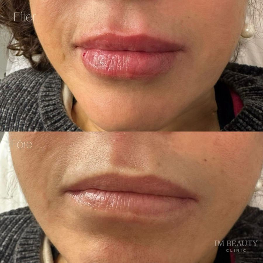 Russian Lips, före och efter